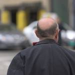 Male pattern baldness is a medical condition that only affects men