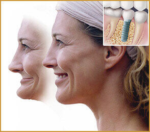  Teeth implants placing the new tooth and keeps the jawbone in action